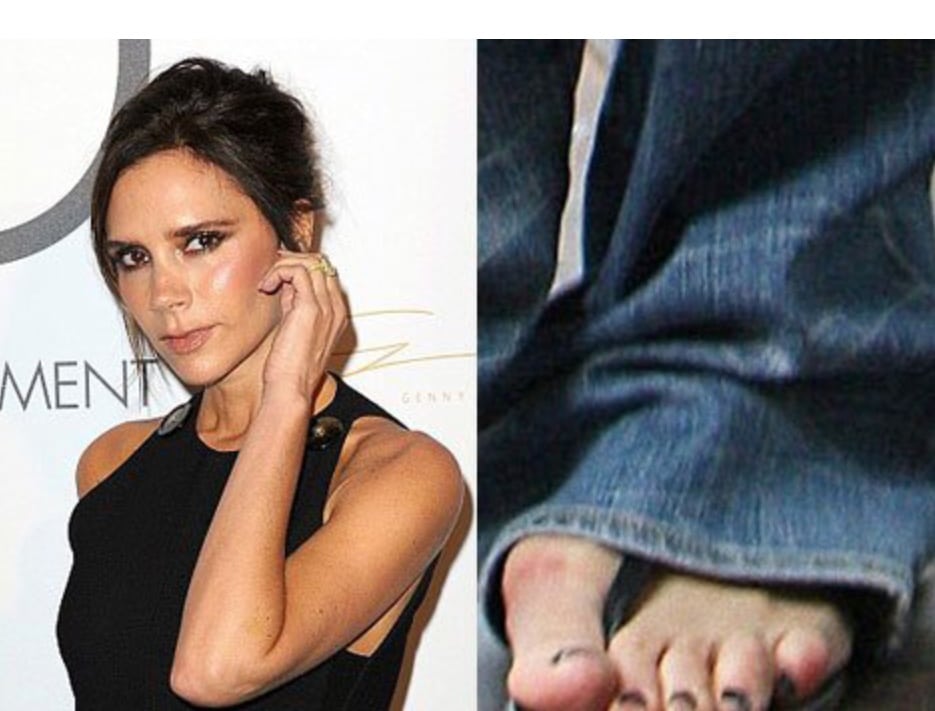 celebrity bunion