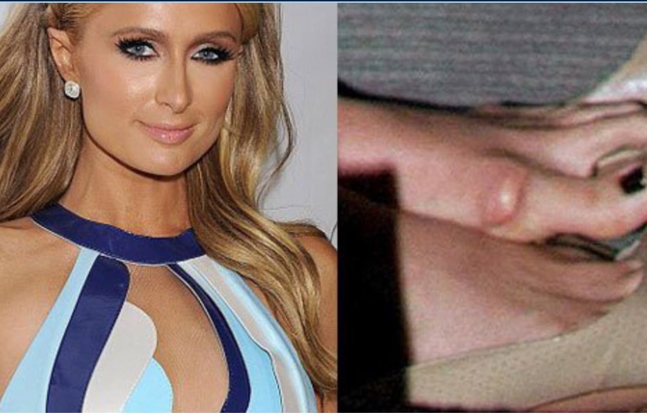 celebrity with bunion