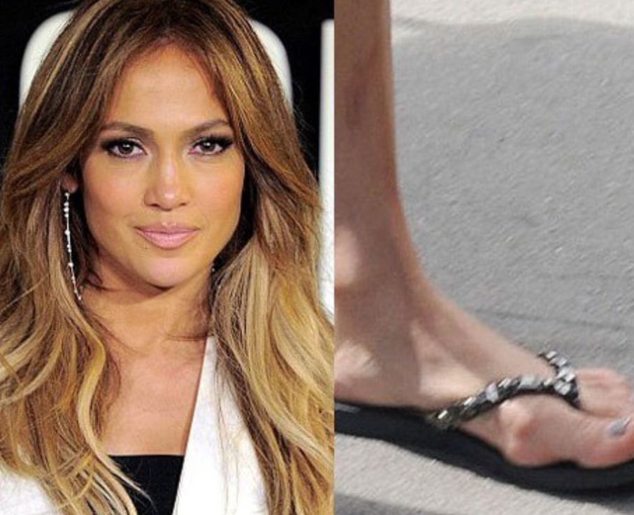 celebrity with bunion