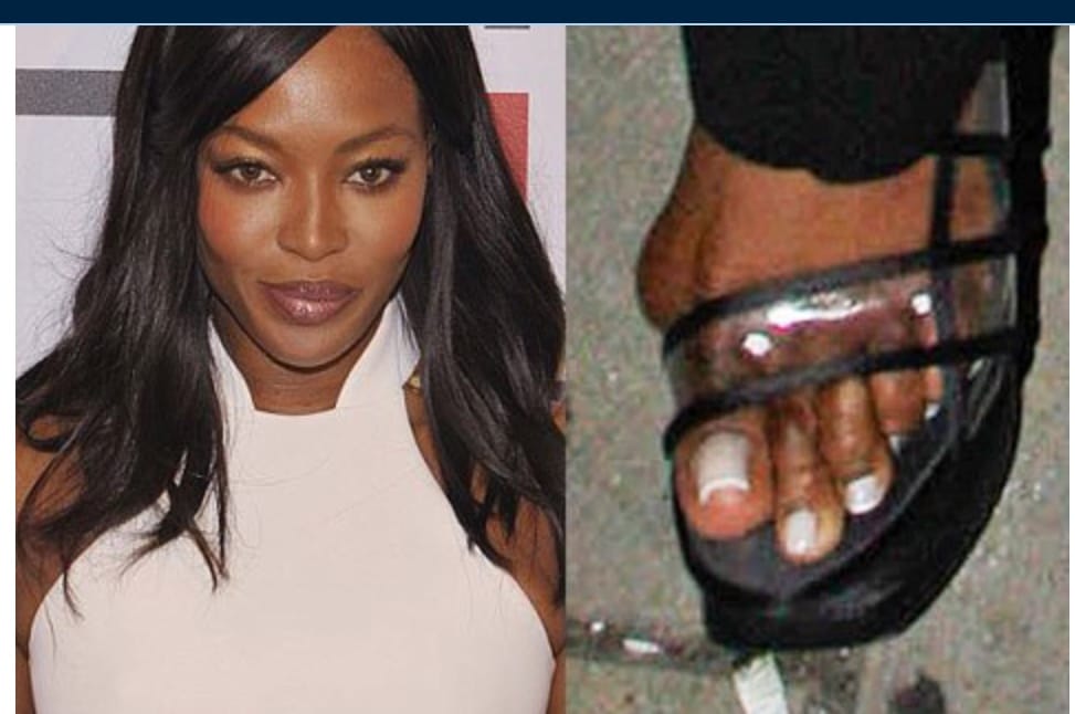 celebrity with bunion