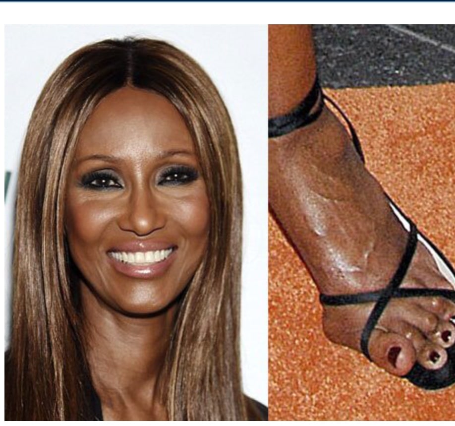 celebrity with bunion