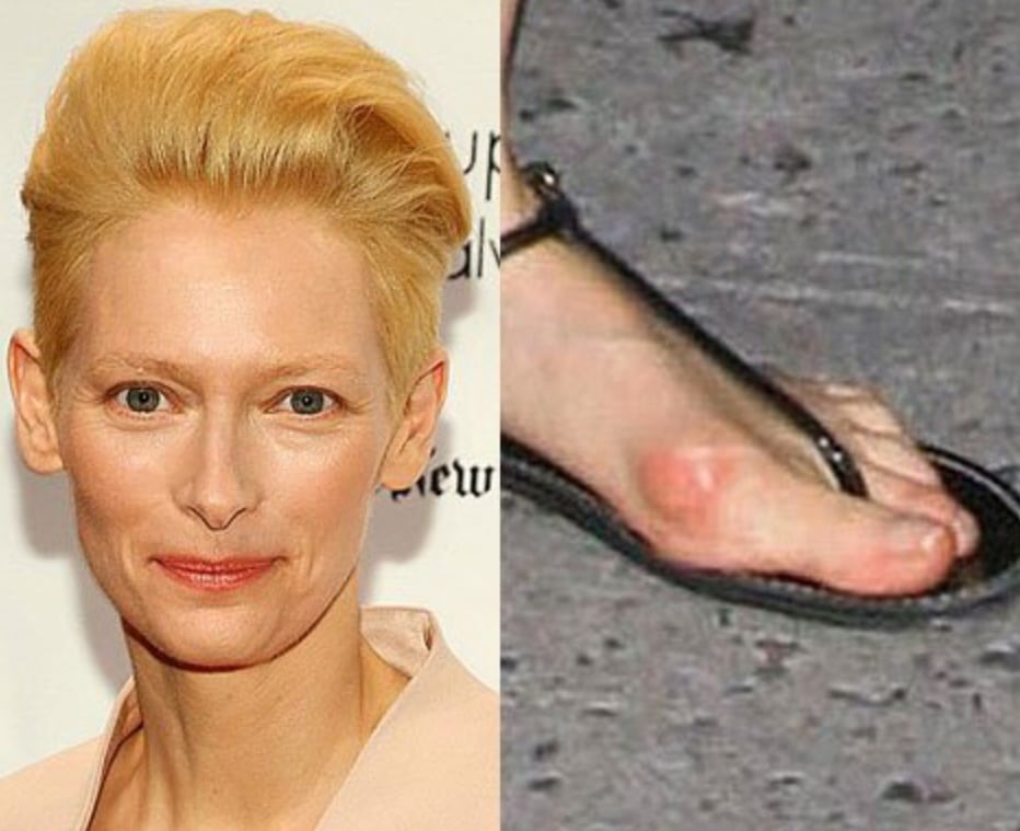 celebrity with bunion