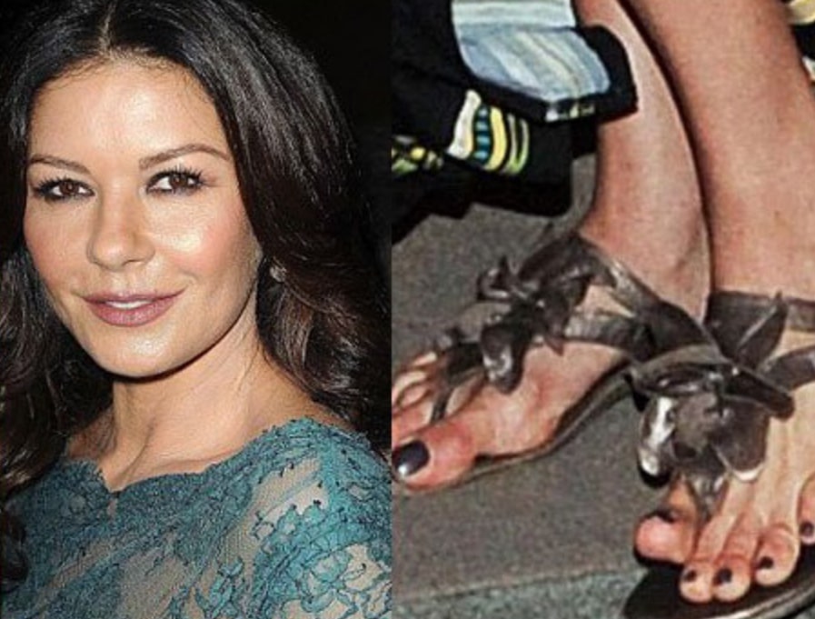 celebrity with bunion